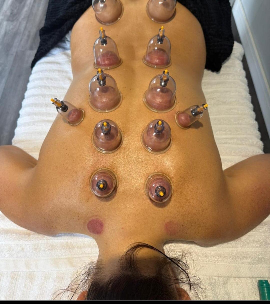 Cupping